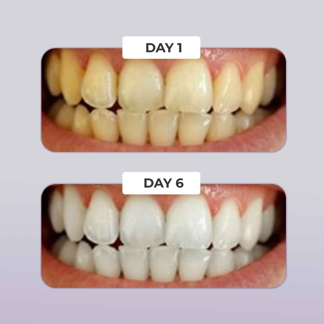 PUURSMILE TEETH WHITENING KIT - 50% OFF CHRISTMAS SALE - Image 4