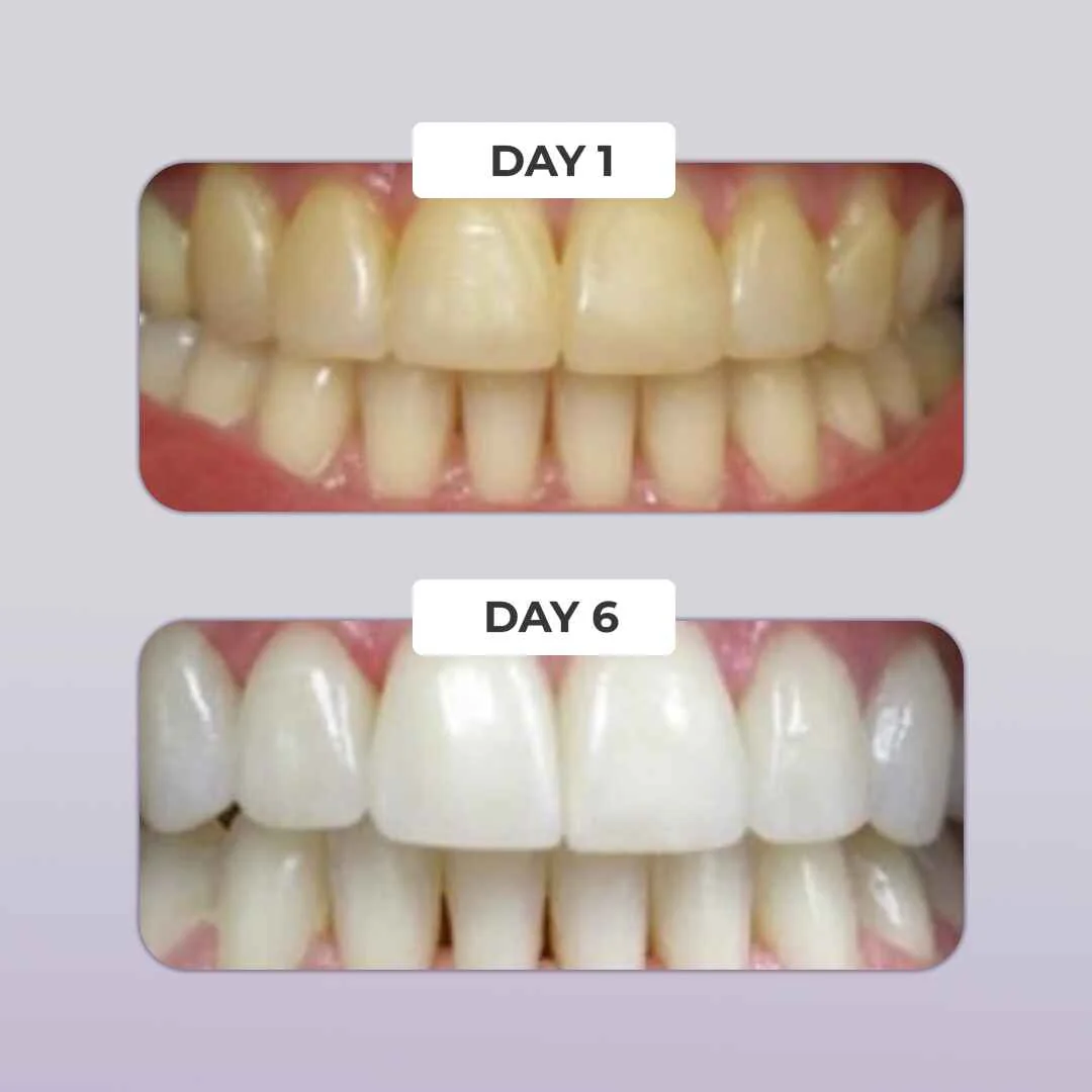 PUURSMILE TEETH WHITENING KIT - 50% OFF CHRISTMAS SALE - Image 5